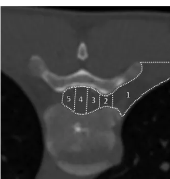 FIG 3. Examples of successful ventral epidural spread of contrast (optimal epidurograms).midline in the ventral epidural space ( A, A 48-year-old woman with a ventral CSF leaktreated via left T7–8 transforaminal approach ventral patch