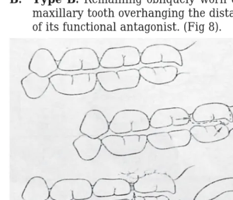 Fig 11: Class II Type B & C Food Impaction.