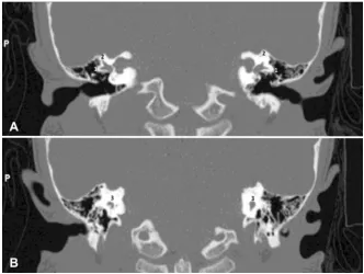 Figure 3. Graphical representation of hearing and language catego-represents numbers of hearing (Geers) and language categories (Be-implantation; PRE CI = pre-cochlear implantation, Numbers 1 to 6 ries, pre- and post-cochlear implantation