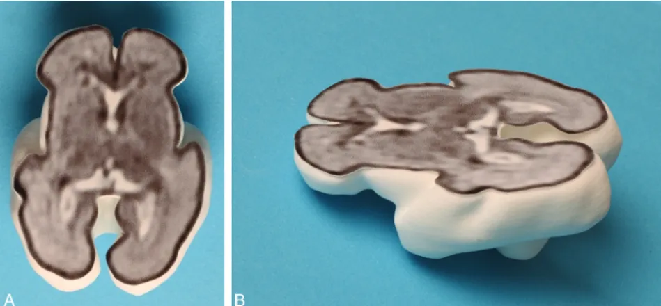 FIG 3. A 3D printed model produced via laser sintering with the internal anatomy of the brain shown from an attached 2D single-shot fastspin-echo image to produce a section of the fetal brain—superior (A) and oblique (B) projections.