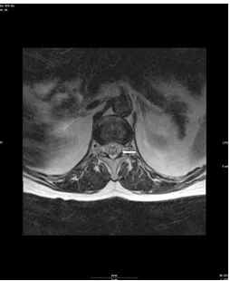 Figure 3 Diffusion weighted imaging reveals that there is restricted diffusion in this area (arrow).