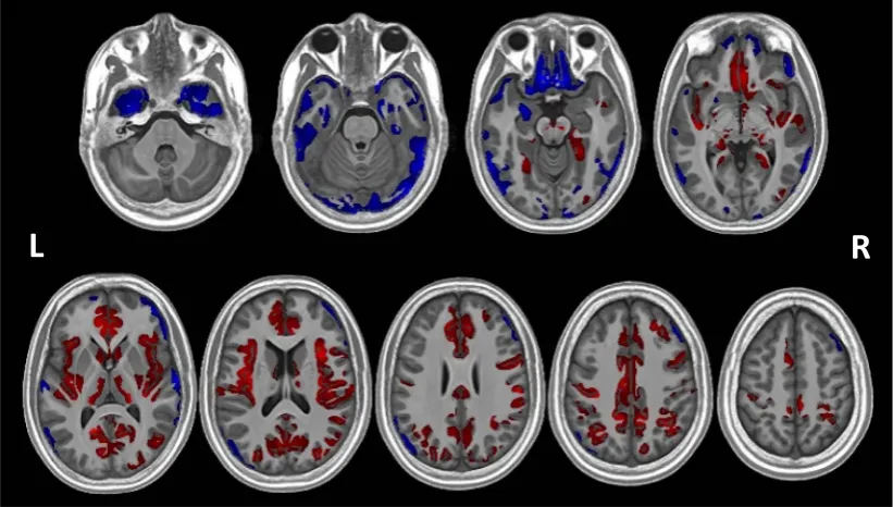 Fig. 2 shows areas of the cortex with increased and decreasedPWS compared to the typically developing control group