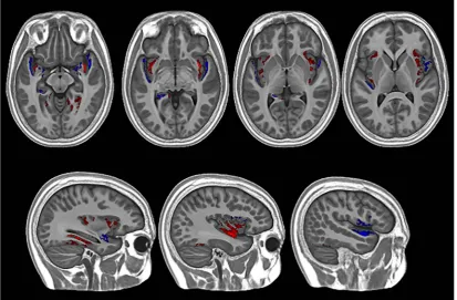 Fig. 2. Findings from the whole-brain nonparametric GLM analysis showing clusters where cortical thickness diﬀered signiﬁcantly between the PWS and control groups