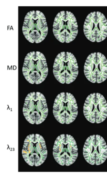 FIG 3. Group differences in FA, MD, axial diffusivity (�1), and radial diffu-sivity (�23) between the DM-MCI and the HC groups in 3 representativesections (see On-line Fig 2 for a complete set of images with whole-braincoverage)