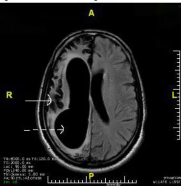 Figure 1: MRI of the brain with gadolinium enhancement  