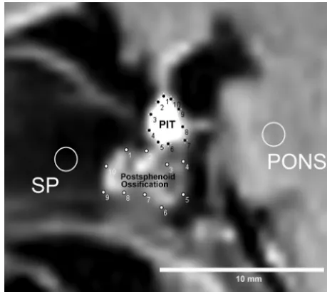 FIG 1. Method of ROI analysis. First, 10 points are manually placed on thecontour of both the pituitary (PIT) and postsphenoid ossiﬁcation, and around ROI (diameter, 5 pixels) is drawn on both the pons and sphenoidbone