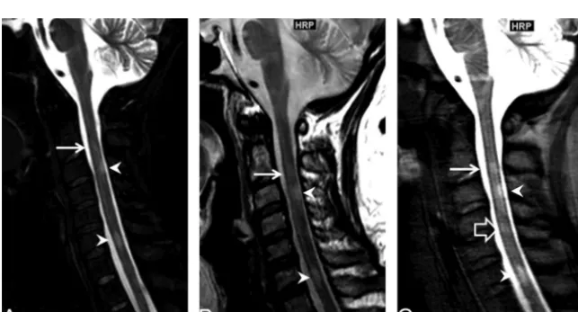 FIG 2. Example of improved lesion conspicuity in a 45-year-old woman with a relapsing-remittingsubtype of multiple sclerosis