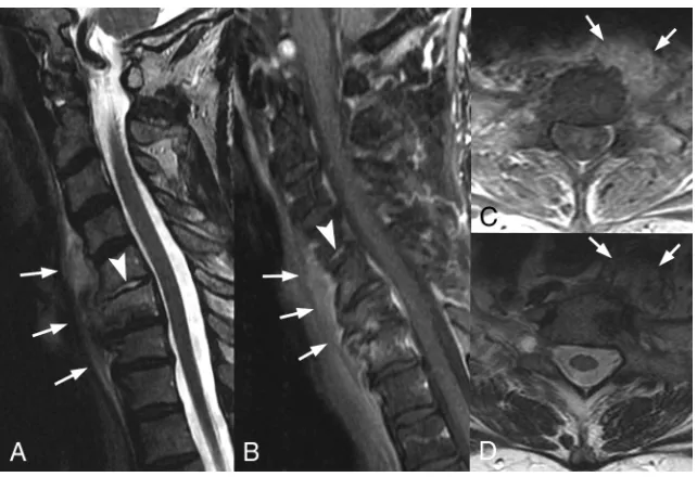 FIG 3. MR images in a 32-year-old woman with back pain. Sagittal T1-weighted fat-saturatedimages of the thoracic spine following administration of gadolinium demonstrate multilevelenhancement (arrows) of the spinous processes (B) and bilateral facet joints (A and C).