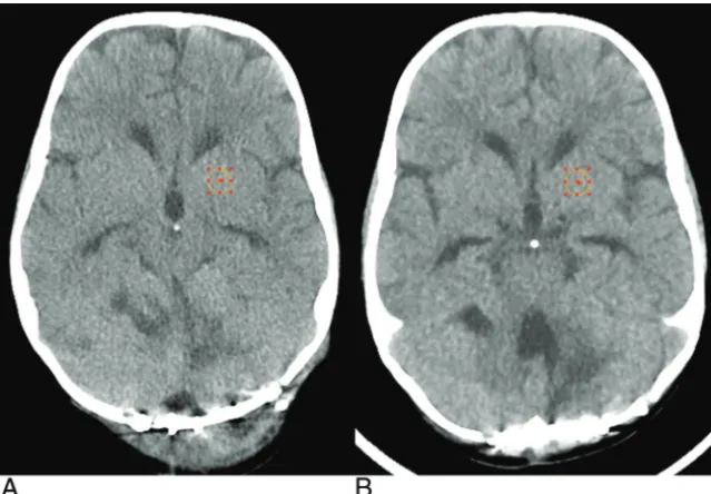 FIG 5. A 3-year-old boy with scans 6 months apart.postsurgery with the dose-reduced brain protocol by using 60% ASIR, 120 mA, and 100 kVp, witha CTDI A, The original brain protocol is acquired at200 mA and 100 kVp with a CTDIvol of 25.1 mGy by using FBP