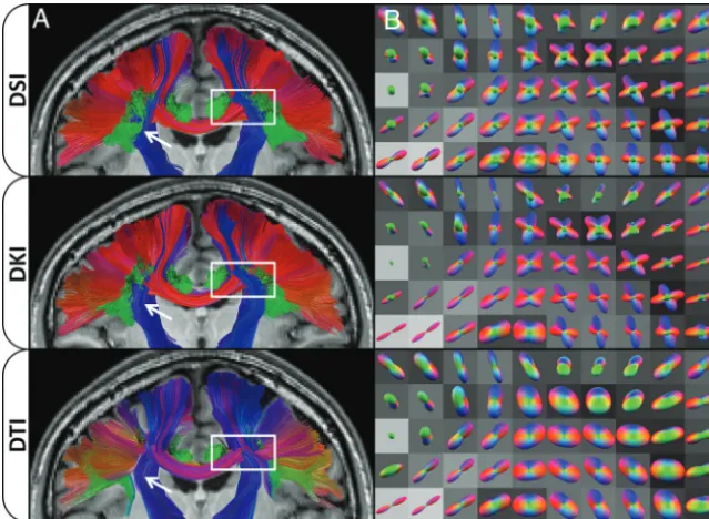 FIG 4. Effects of dODF reconstructions on WM tractography. Columndemarcated by theously affected in this region because the dODFs cannot detect crossing ﬁbers; this feature causesﬁbers to prematurely terminate or meld anatomically distinct tracts