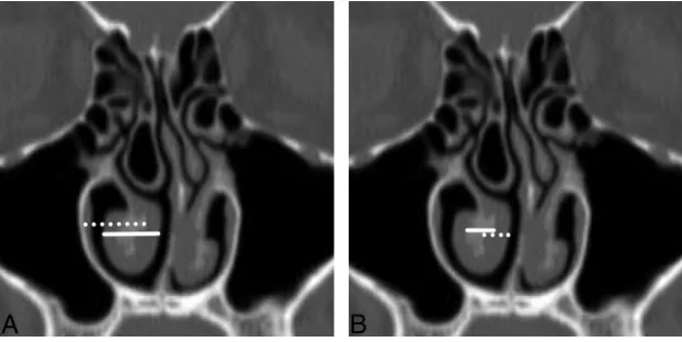 FIG 2. Coronal reformatted image from noncontrast sinus CT demonstrates the measurementssion of the soft tissue along the medial aspect of the inferior turbinate (medial mucosa width) isidentiﬁed with aof soft tissue and bone (width) is depicted by theof i