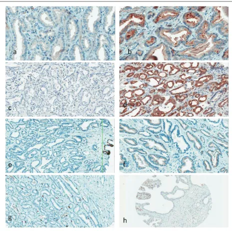 Fig. 1. Examples of different immunohistochemical staining in tissue microarray cores:plasm of PCa cells, dnegative prostate cancer (PCa),  a – EMA-b – EMA-positive PCa epithelium, c – p16-negative PCa glands,  – p16-positive PCa cells, e – AMACR-negative cytoplasm of PCa cells, f – AMACR-positive cyto-g – some Ki67-positive PCa cell nuclei, h – some p53-positive PCa cell nuclei