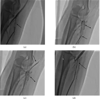 Figure 1. Male, 43 years old, radial artery spasm together with severe dissection. (a): row)