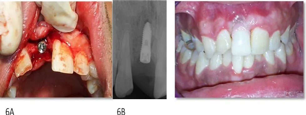 Figure 6: A) & B) Two-piece implant placement (AB 3.25 x 9.5mm