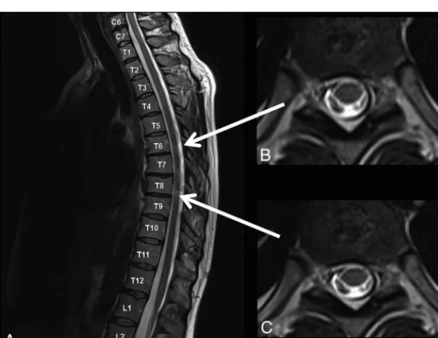 FIG 2. Examples of a cervical (1A and 1B) and a thoracic (2A and 2B) spinal cord lesion detected onaxial scans but missed by both raters on corresponding sagittal scans.