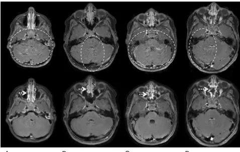 FIG 4. Representative water-reconstructed images from patients 1 (A), 4 (B), 18 (C), and 22 (D), comparing ﬂow artifacts between Cartesian TSE(top) and spiral SE sections (bottom)