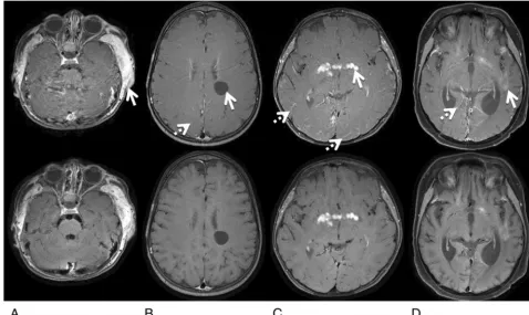 FIG 5. Representative images with lesions from patients 2 (A), 8 (B), 15 (C), and 20 (D), comparing lesion conspicuity between Cartesian TSE (top)and spiral SE sections (bottom)