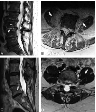 FIG 1. The imaging psoas sign on noncontrast MR imaging of the lumbar spine in an 81-year-old manwith renal failure, E faecalis bacteremia, and clinically diagnosed discitis-osteomyelitis (A and B) withcomparison with degenerative disc disease (C and D)