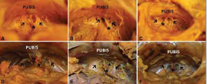 Fig. 1. Photographs of pelvic dissections of male cadaveric subjects A-F. The superficial dorsal vein is marked by the asterisk (Ø), while the puboprostatic ligaments are highlighted by the arrows (Þ).