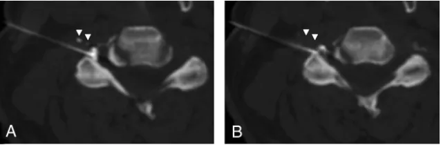 FIG 1. Mixed intravascular and epidural contrast injection. A, Intravascular injection appears asdiscrete foci of contrast (arrowheads) away from the needle tip and adjacent main, epiduralcontrast collection