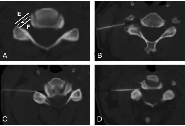 FIG 7. Needle depth classiﬁcation. A, The lateral junction of the neural foramen (dotted line) isdeﬁned by a line segment connecting the anterolateral margin of the vertebral body with themost lateral margin of the facet joint