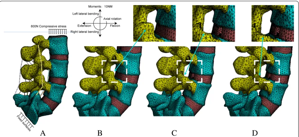 Fig. 3 The magnetic resonance imaging (MRI) of patients subjected to PTED with different grades of facetectomy