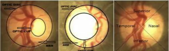 Fig. 1: Enlarged view of normal & affected eye with glaucoma A. Normal non-glaucoma eye (b) Neo-vascular glaucoma affected eye  