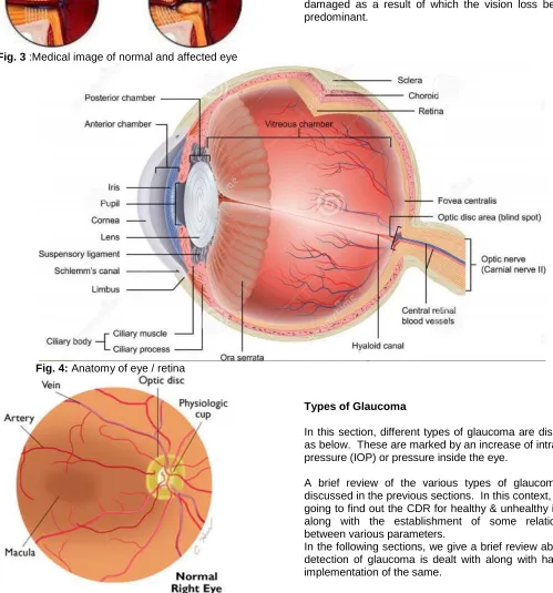 Fig. 3 :Medical image of normal and affected eye 