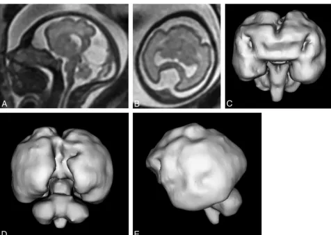 FIG 3. T2-weighted images (single-shot fast spin-echo) in a 24-week gestational age fetus with alobar holoprosencephaly according to theDeMyer classiﬁcation and a severity score of 20/20 (case 2)