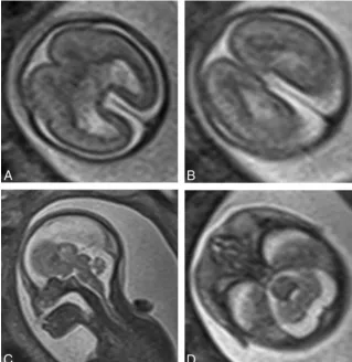 FIG 5. T2-weighted images (single-shot fast spin-echo) of a 21-week gestational age fetus withlobar holoprosencephaly according to the DeMyer classiﬁcation and a severity score of 7/20(case 15)
