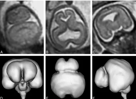 FIG 6. T2-weighted images (single-shot fast spin-echo, A–C) and surface reconstructions of 3D steady-state (FIESTA) data of the brain (D–F) ina 21-week gestational age fetus with lobar holoprosencephaly and a severity score of 9/20 (case 20)