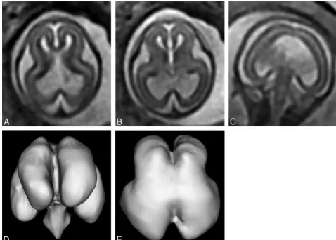 FIG 7. T2-weighted images (single-shot fast spin-echo,of a 19-week gestational age fetus with the interhemispheric fusion variety of holoprosencephaly and a severity score of 2/20 (case 25)