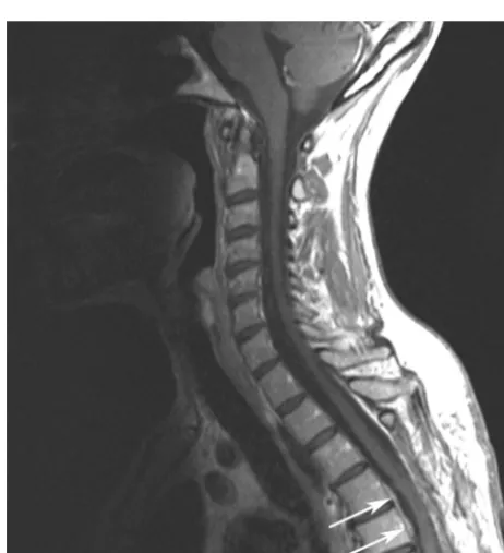 FIG 1.) at the T6–T7 level (site of herniation) and a posterior ﬂuid collection along the laminectomy (ﬂuid collection (straight arrow), and a thick posterior ﬂuid collection (black arrowheadsspinal cord (),shows the position of the spinal cord in the intr