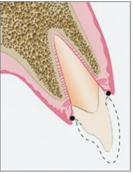 Figure 3: Picture showing placement of the second cord inferior to the prepared margin at crest level