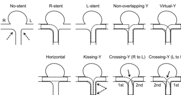 FIG 1. An example of stent placement in a silicone model and an image of stents by micro-CT arestent.image shows a narrowed structure (shown