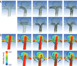 FIG 4. A, Evaluation of ﬂow distribution. In each model, 100 streamlines at diastole are drawnfrom the inlet