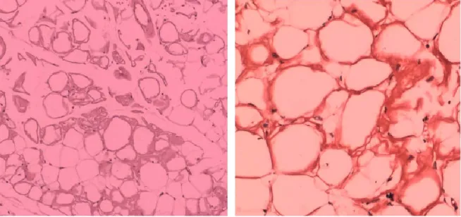 Figure 3. Abdominal fat pad biopsy revealed amyloid type changes of subcutaneous fat immunohistochemisty: Lambda (weak +); Congo (+)