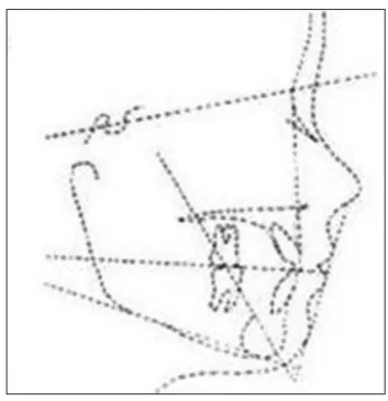 Figure 25: Steps in Holdaway’s visual treatment 