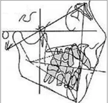Figure 1: Steps in Rickett’s visual treatment objective