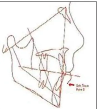 Figure 10: Steps in Rickett’s visual treatment objective