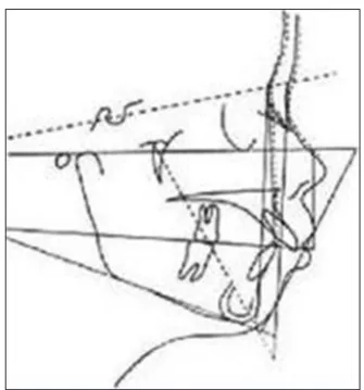 Figure 15: Steps in Holdaway’s visual treatment objective