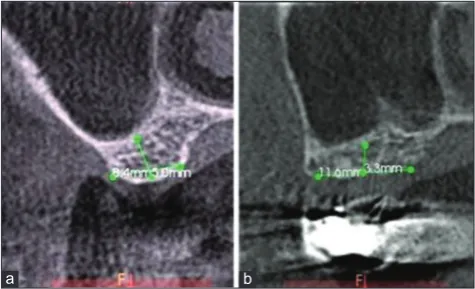 Figure 1: (a) Pre-operative computed tomography (CT) scan shows insufficient height of bone (5.0 mm) and was selected under Group A; (b) Pre-operative CT scan shows insufficient height of bone (3.3 mm) and was selected under Group B