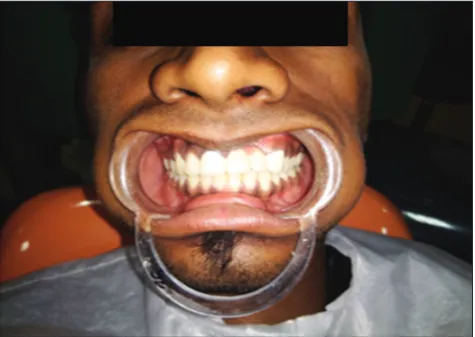 Figure 7: Master impression was made using a putty and light body wash impression technique with vinyl polysiloxane impression material