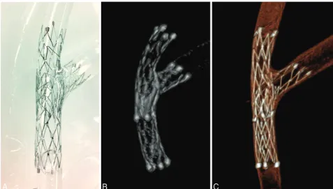 FIG 1. Comparison of the image quality of conventional C-arm CT versus high-resolution C-arm CT.C-arm CT.placed at the bifurcation of a silicone vessel model by using a stent-in-stent technique