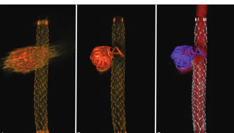 FIG 2. Thin-section MIP images of the aneurysms treated with stent-assisted coil embolization