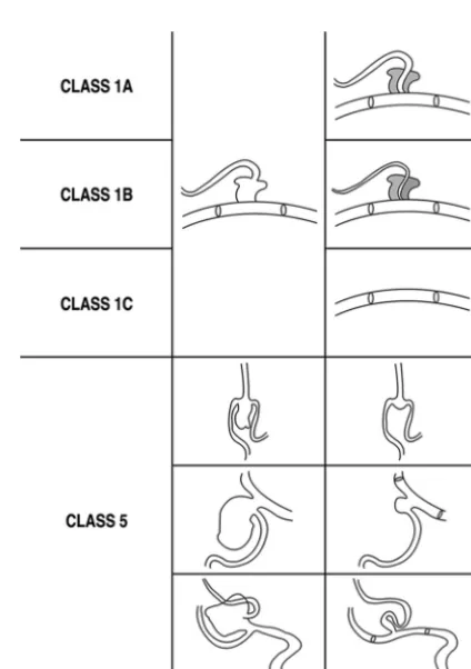 FIG 1. Schematic drawing of class 1 subgroups and class 5 in differentcase settings. The last column shows the control angiographic appear-ance