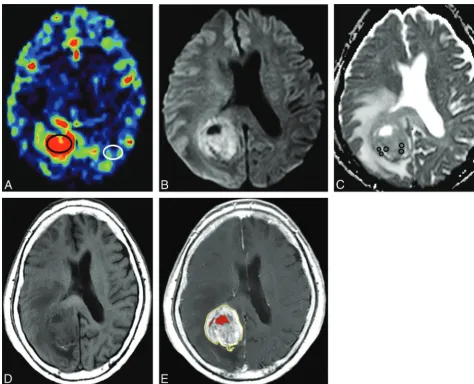 FIG 1. Images showing an example of determination of the TBF (A), ADC (B and C), and necrosis area (D and E)