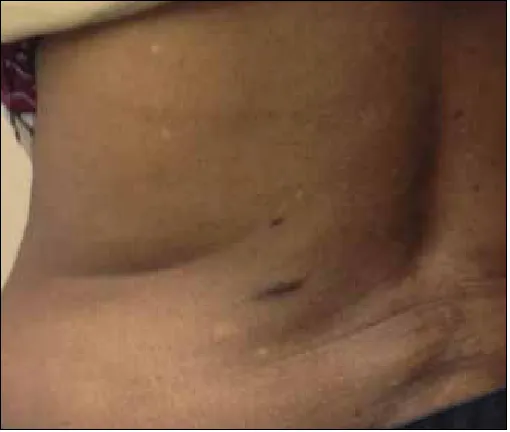 Fig. 3. Computed tomography scan demonstrating colon perforation.