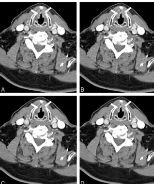 FIG 4.Images of a 46-year-old male patient examined with a low tube voltage of 90 kV onlevels 1 (192-section DSCT (window settings: width, 400 HU; level, 80 HU)