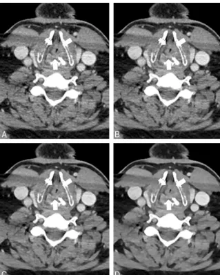 FIG 5. A 58-year-old male patient with sudden dyspnea. CT was performed with a tube voltageof 90 kV (window settings: width, 400 HU; level, 80 HU)